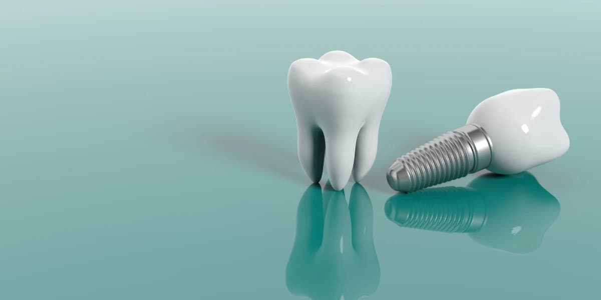 Dental Implants